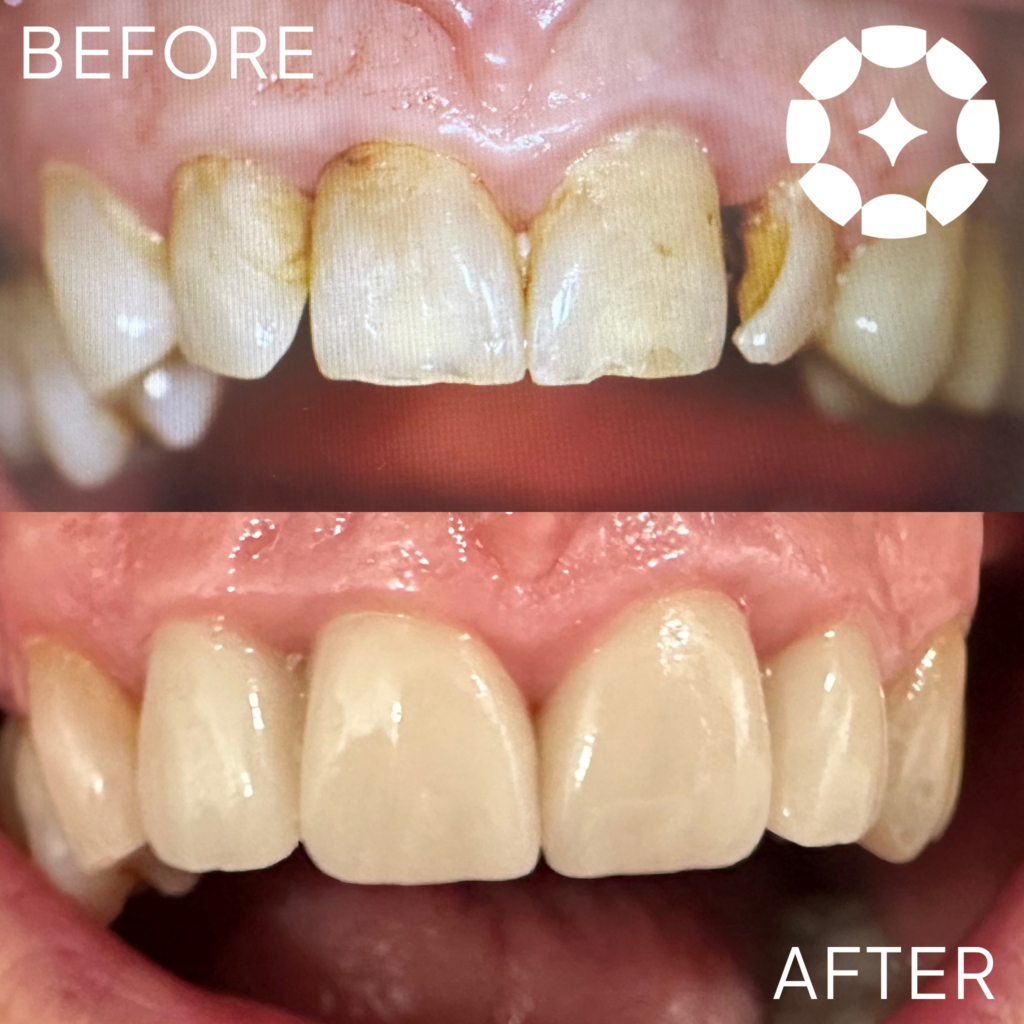 Paschke Dental Group in Venice, FL transforms smiles with strength and precision!