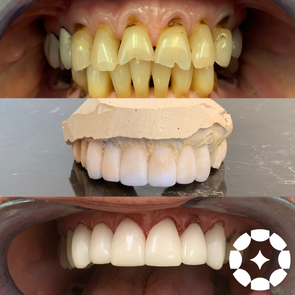Check out this stunning cosmetic dental transformation by Dr. Hollie Paschke and the team at Paschke Dental in gorgeous Venice, Florida!